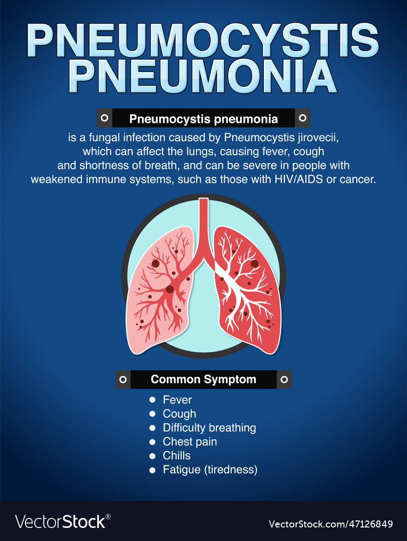 Informative poster of pneumocystis pneumonia Vector Image