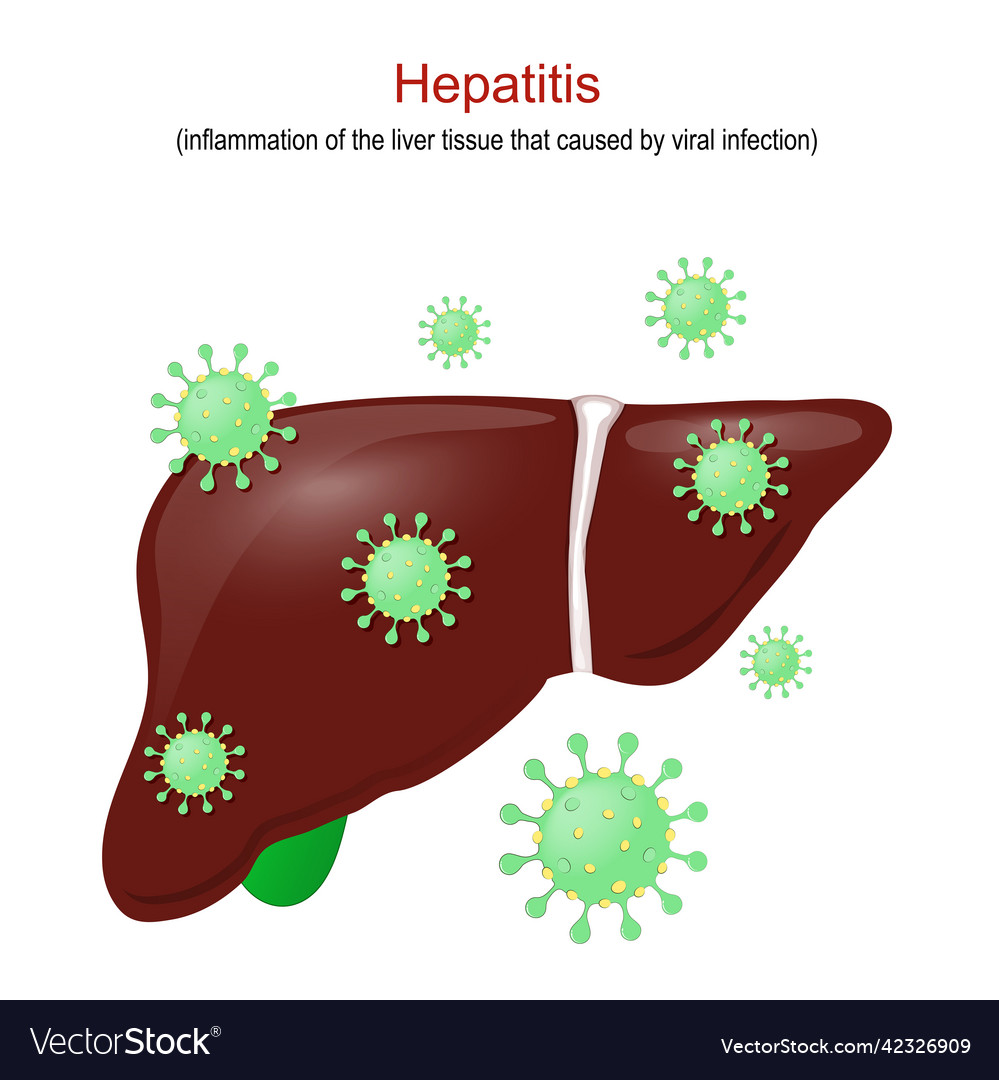 Hepatitis inflammation of the liver tissue Vector Image