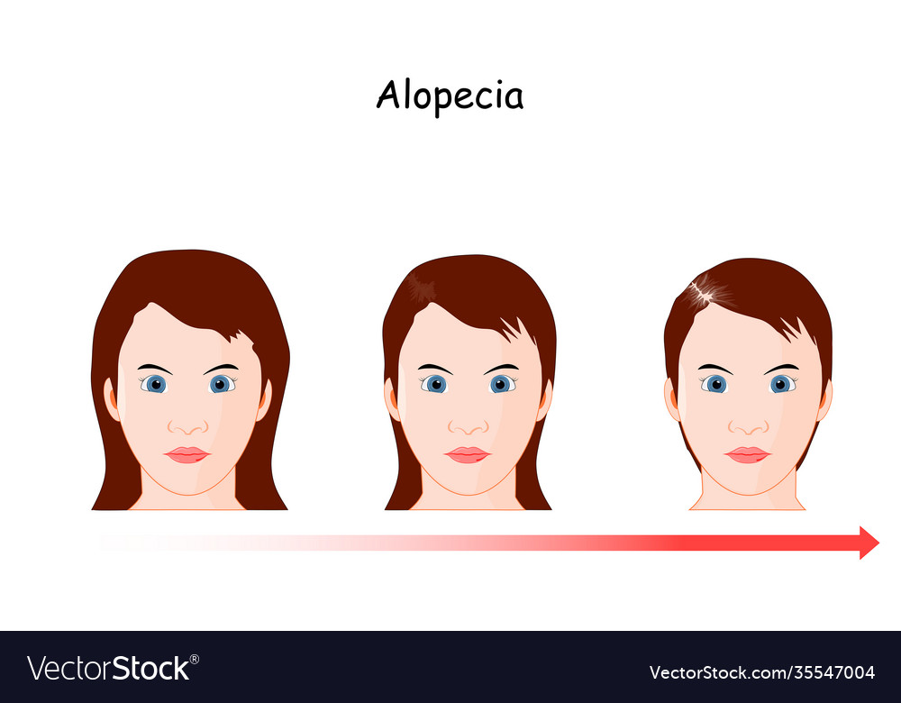 Female Alopecia Development Royalty Free Vector Image