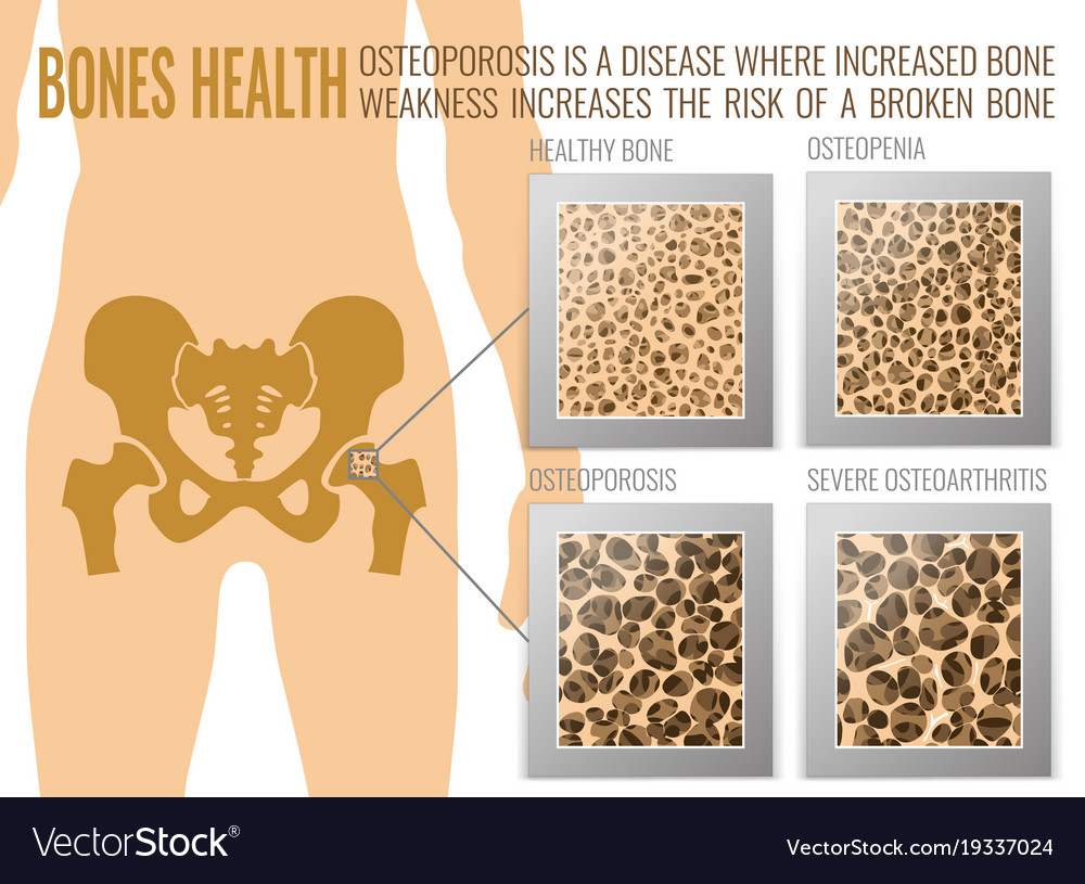 Osteoporose Knochen poster