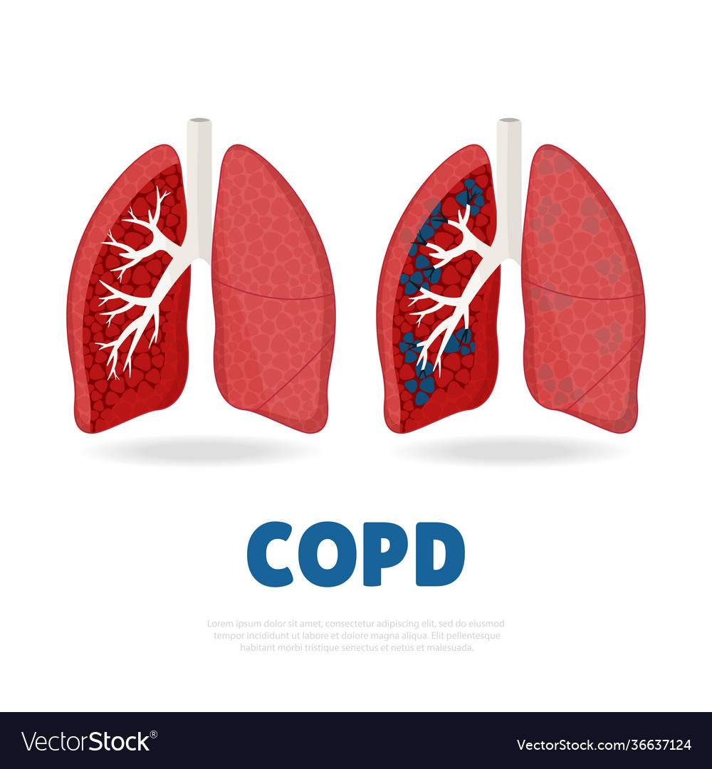 Copd Royalty Free Vector Image - VectorStock