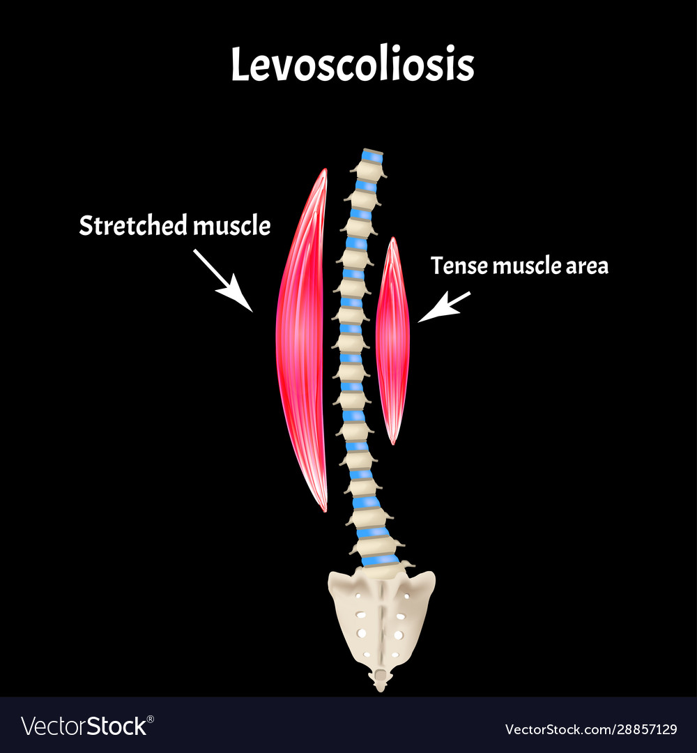 Left-sided scoliosis levoscoliosis muscles and Vector Image