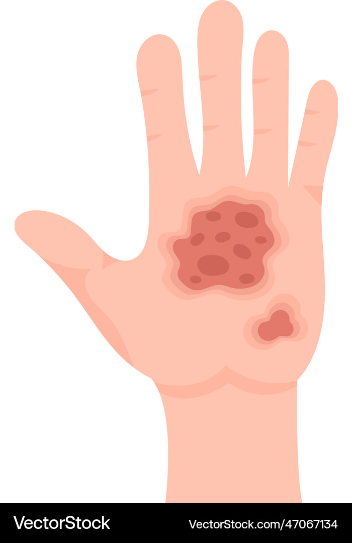 3rd degree of skin burn Royalty Free Vector Image