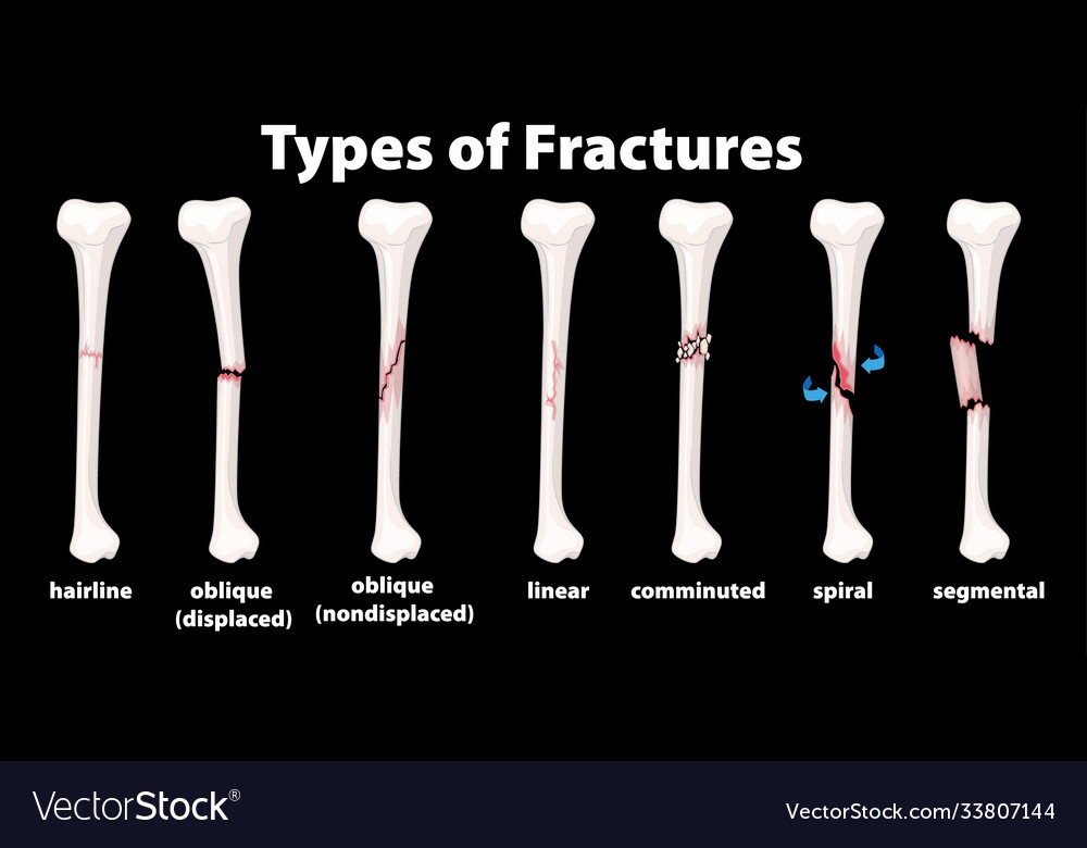 Type fractures diagram Royalty Free Vector Image