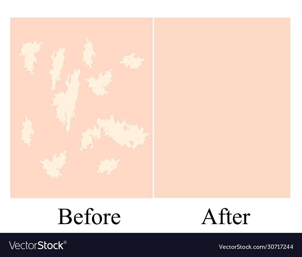 Vitiligo white spots on skin infographics