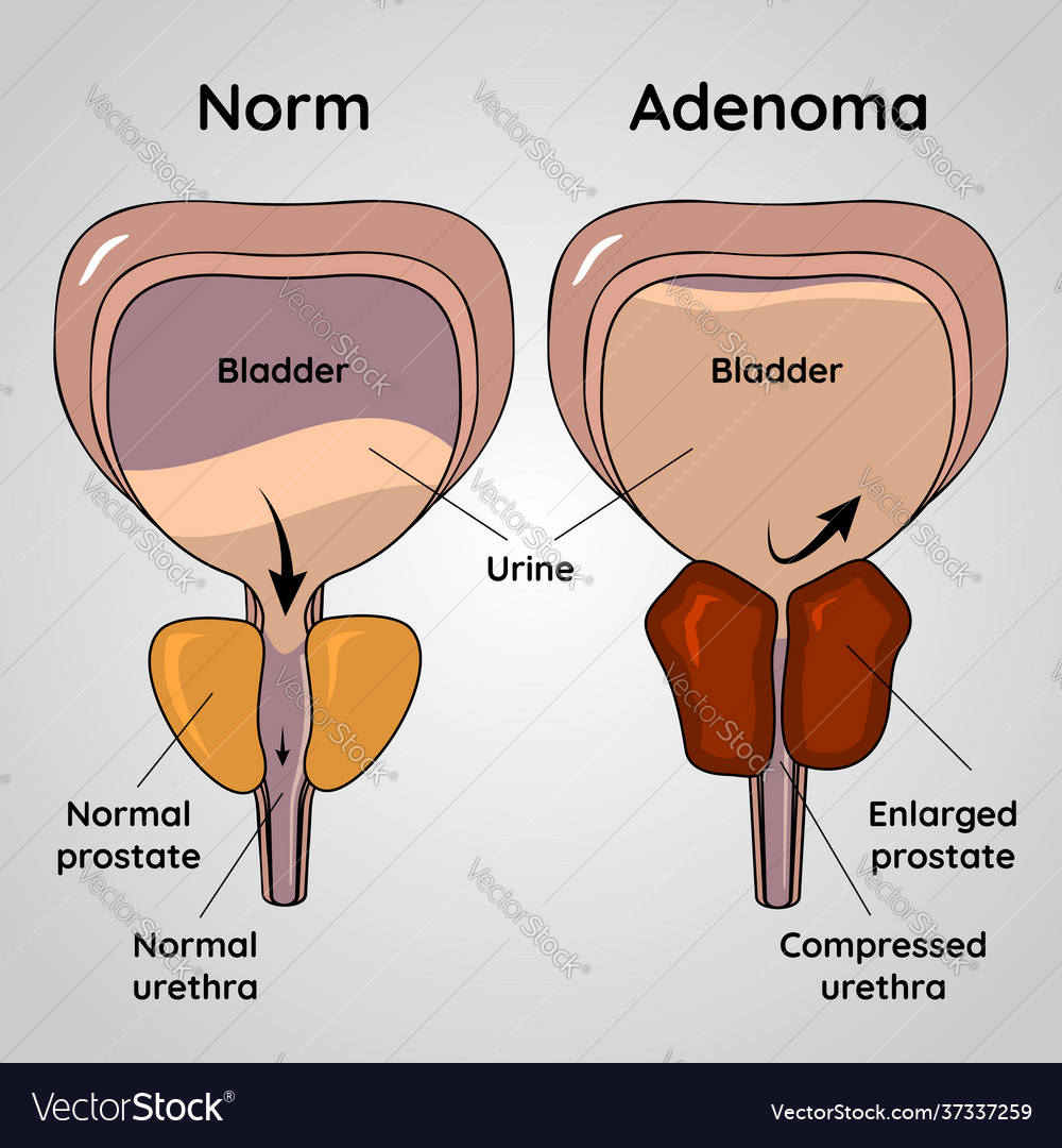 prostate adenoma signs and symptoms)