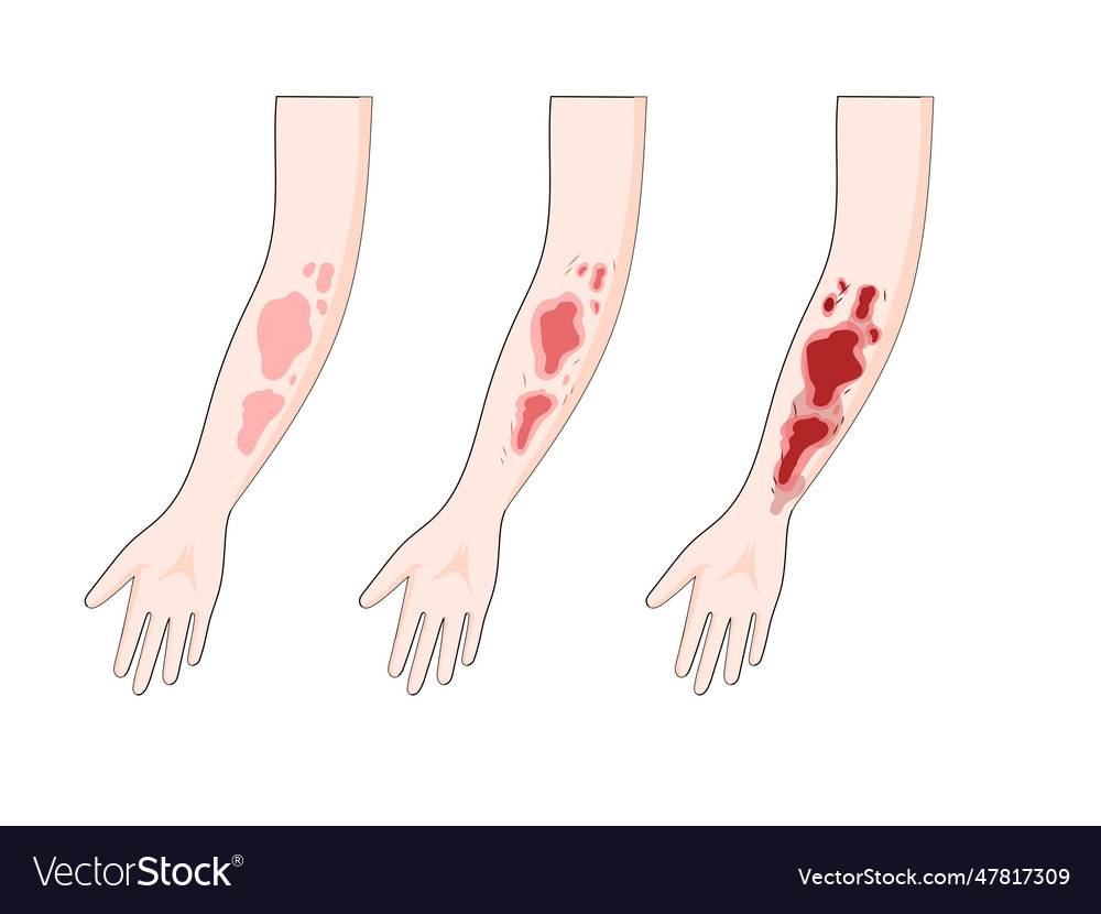 Burn degree diagram medical science Royalty Free Vector