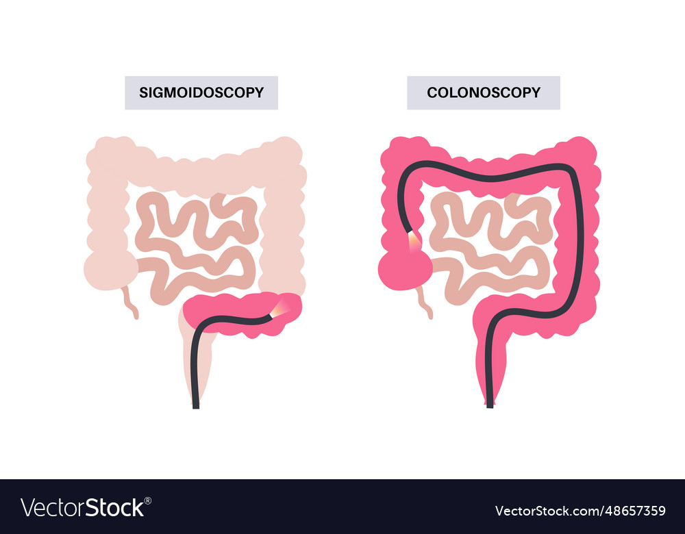 Difference Between Sigmoidoscopy And Colonoscopy
