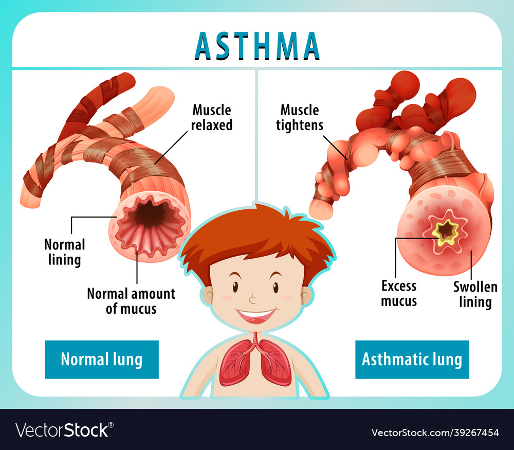 Asthma Diagram With Normal Lung And Asthmatic Lung