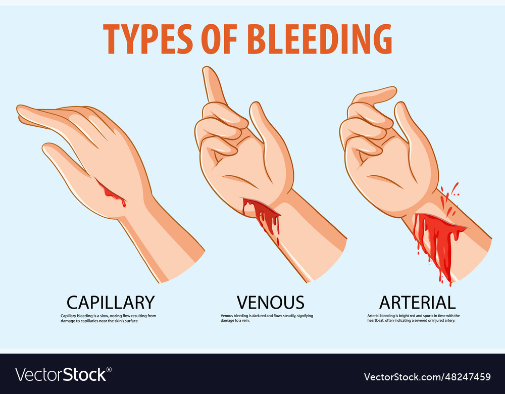 Human hand with different types of bleeding Vector Image