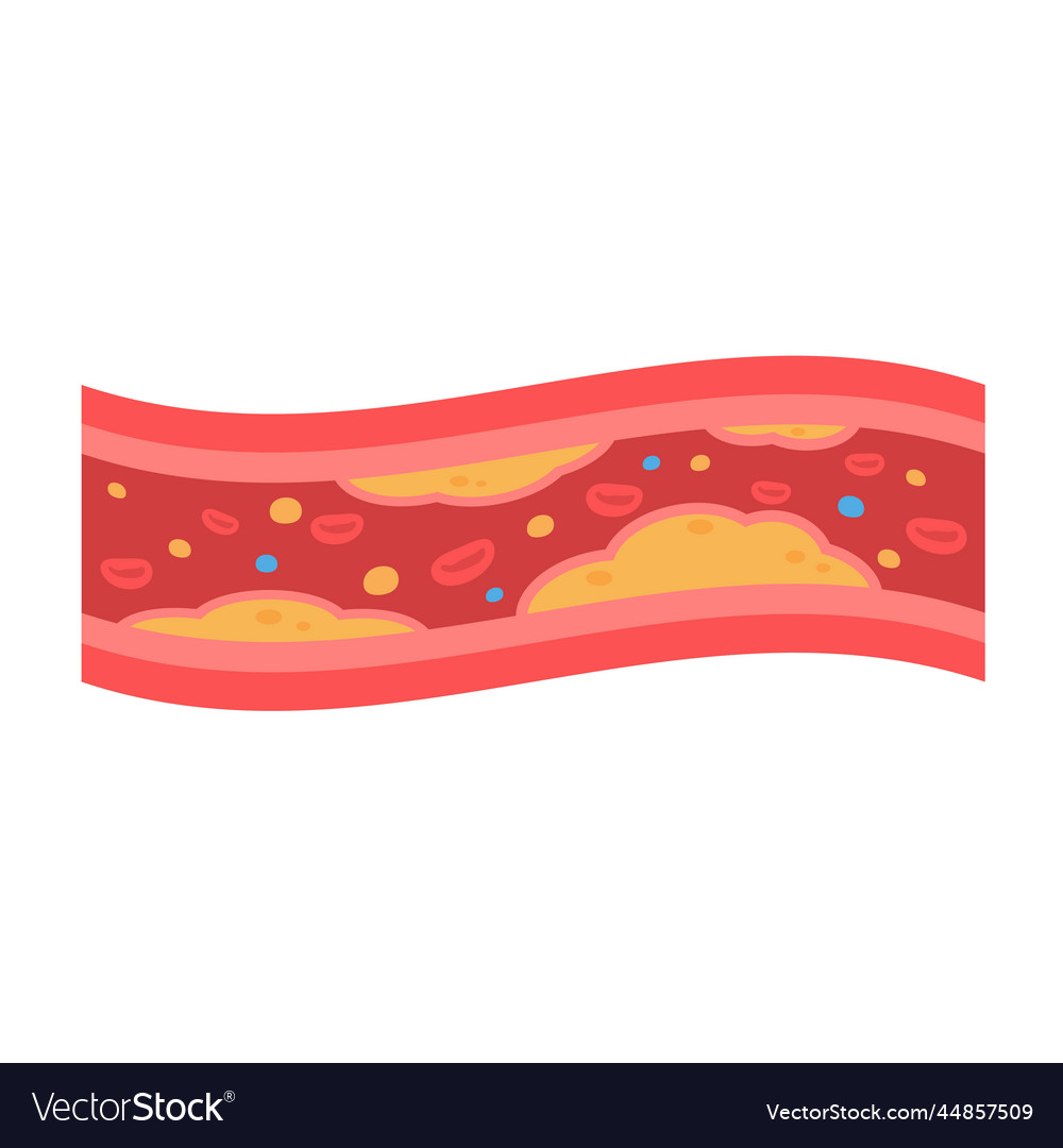 Coronary arteries with accumulated fat in the body