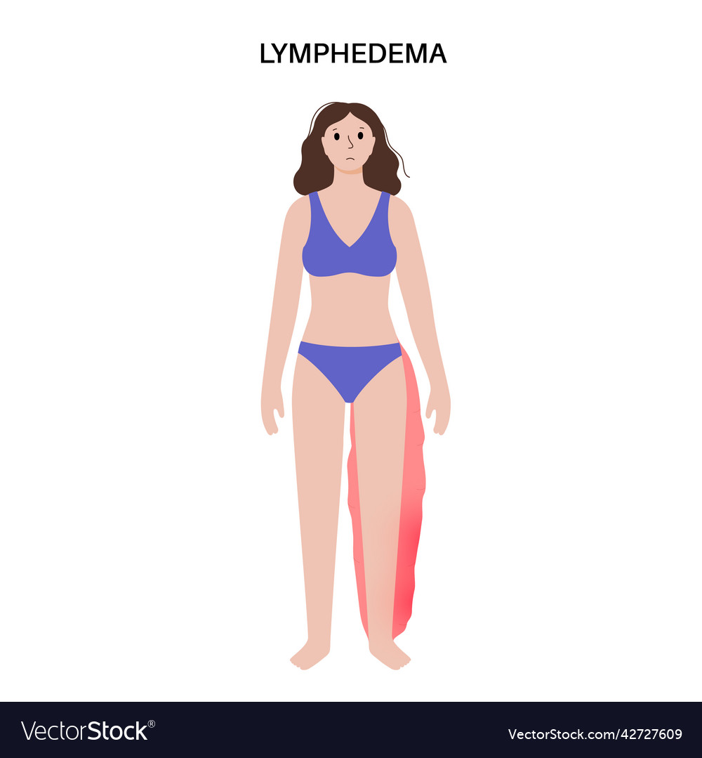 Lymphedema leg swelling