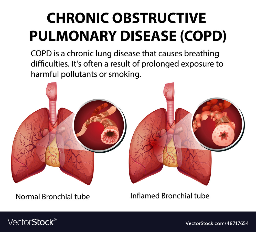 Science education of human anatomy copd Royalty Free Vector