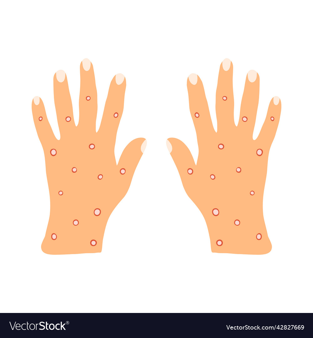 Monkeypox symptoms hand skin rashes blisters Vector Image