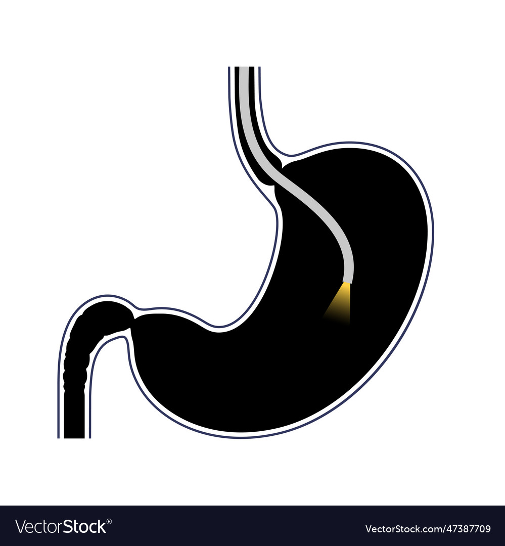 Gastroscopy Endoscopy Procedure Royalty Free Vector Image