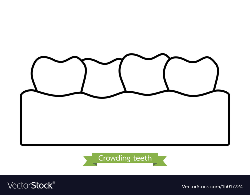 Crowding Zähne oder Malocclusion - Cartoon Umriss