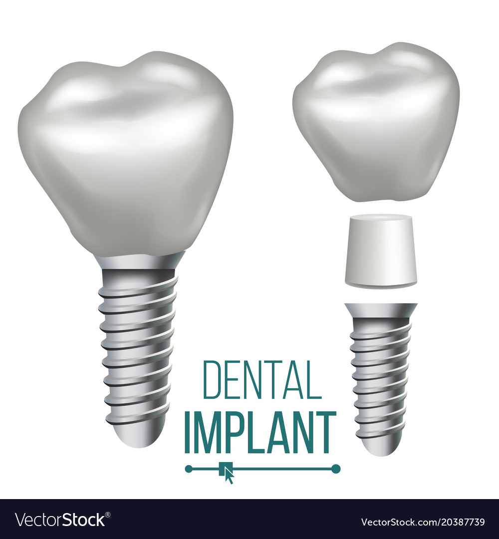 Dental Implant Medical Poster Banner Royalty Free Vector