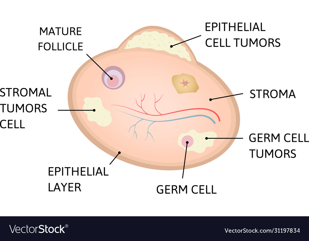 Ovarian cancer epithelial layer germ