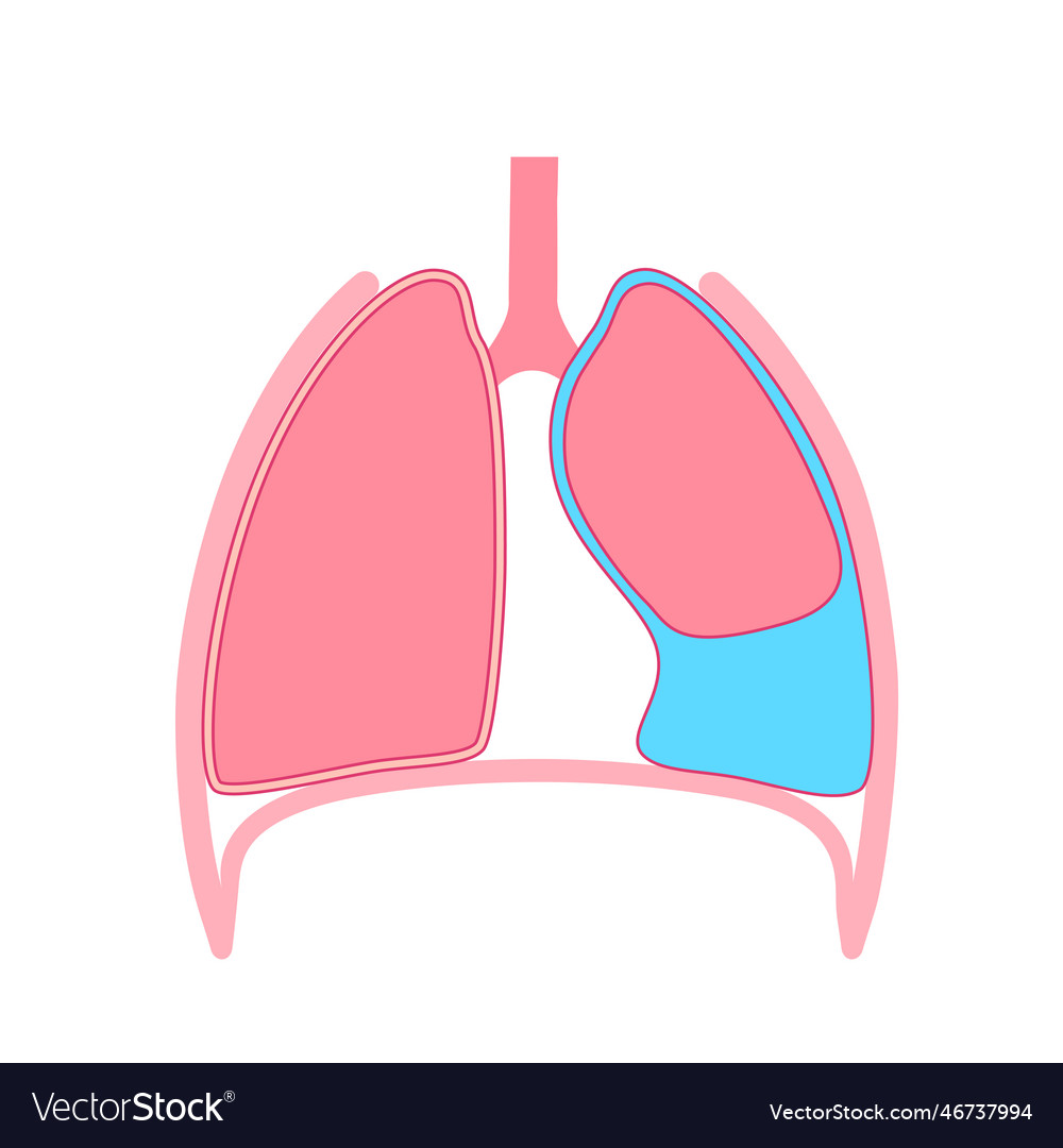 Pleural effusion poster Royalty Free Vector Image