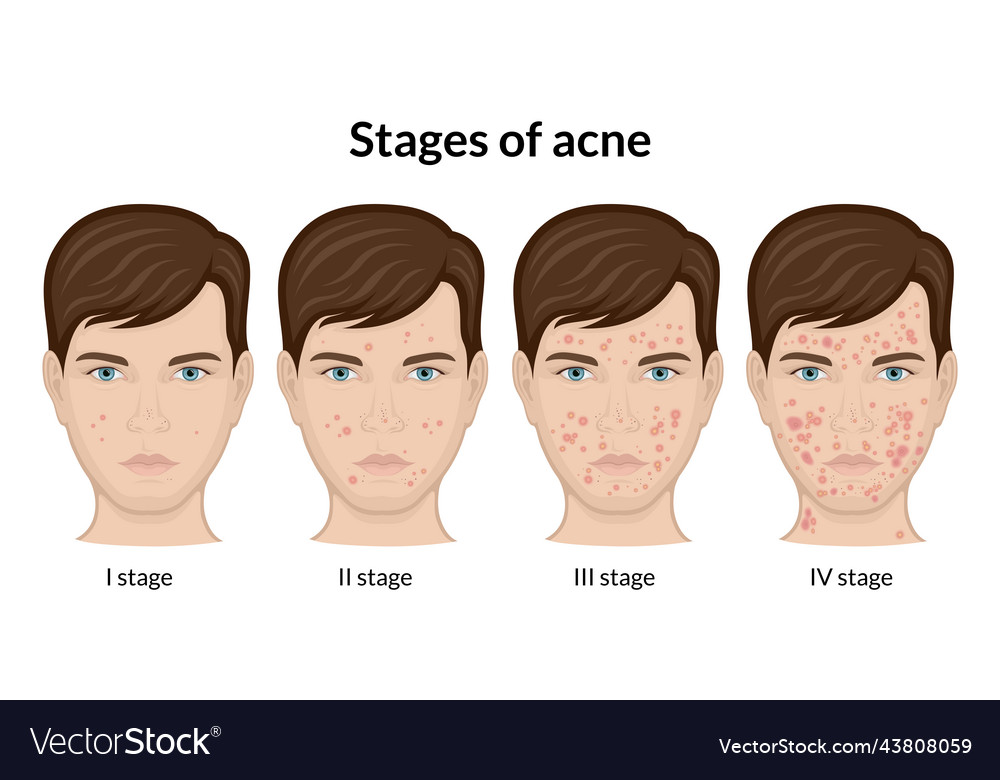 Stages of acne