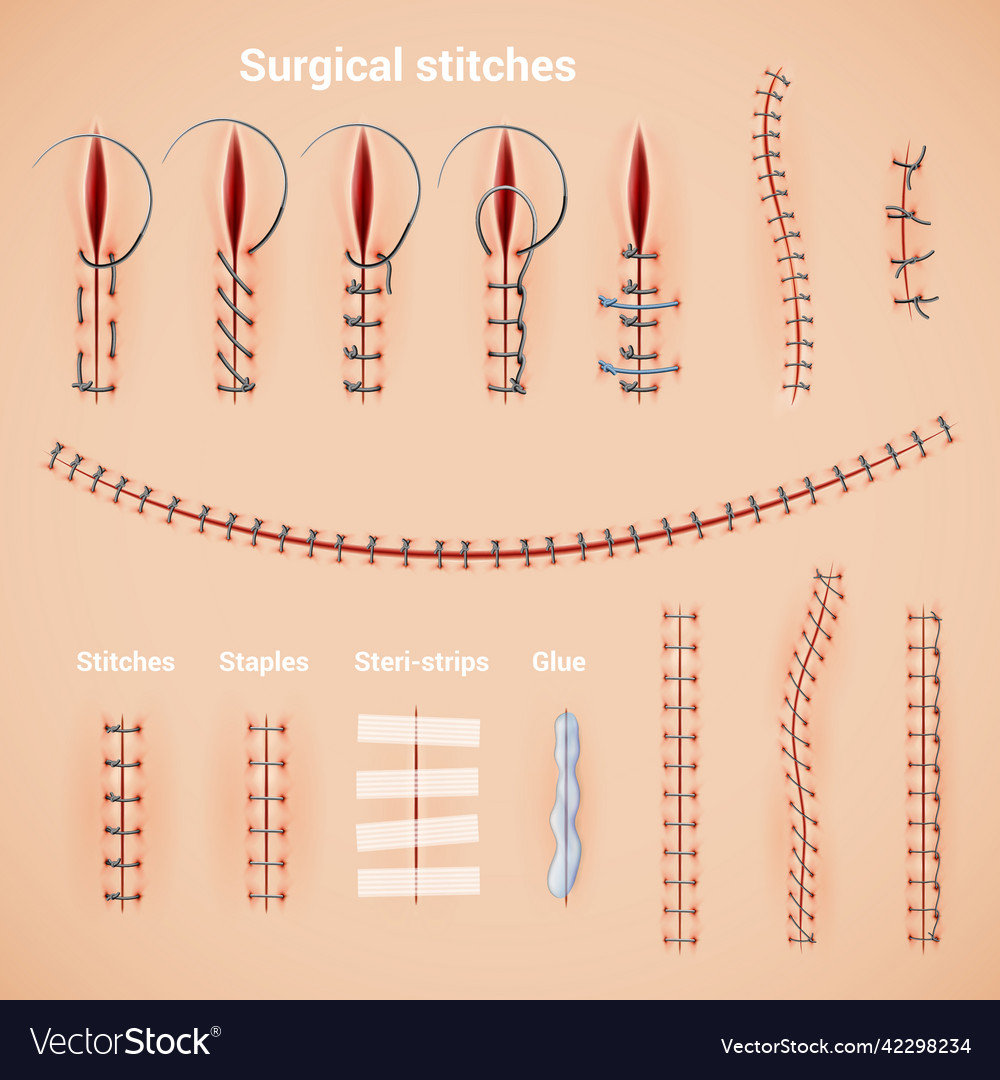 Surgical stitches infographic set Royalty Free Vector Image