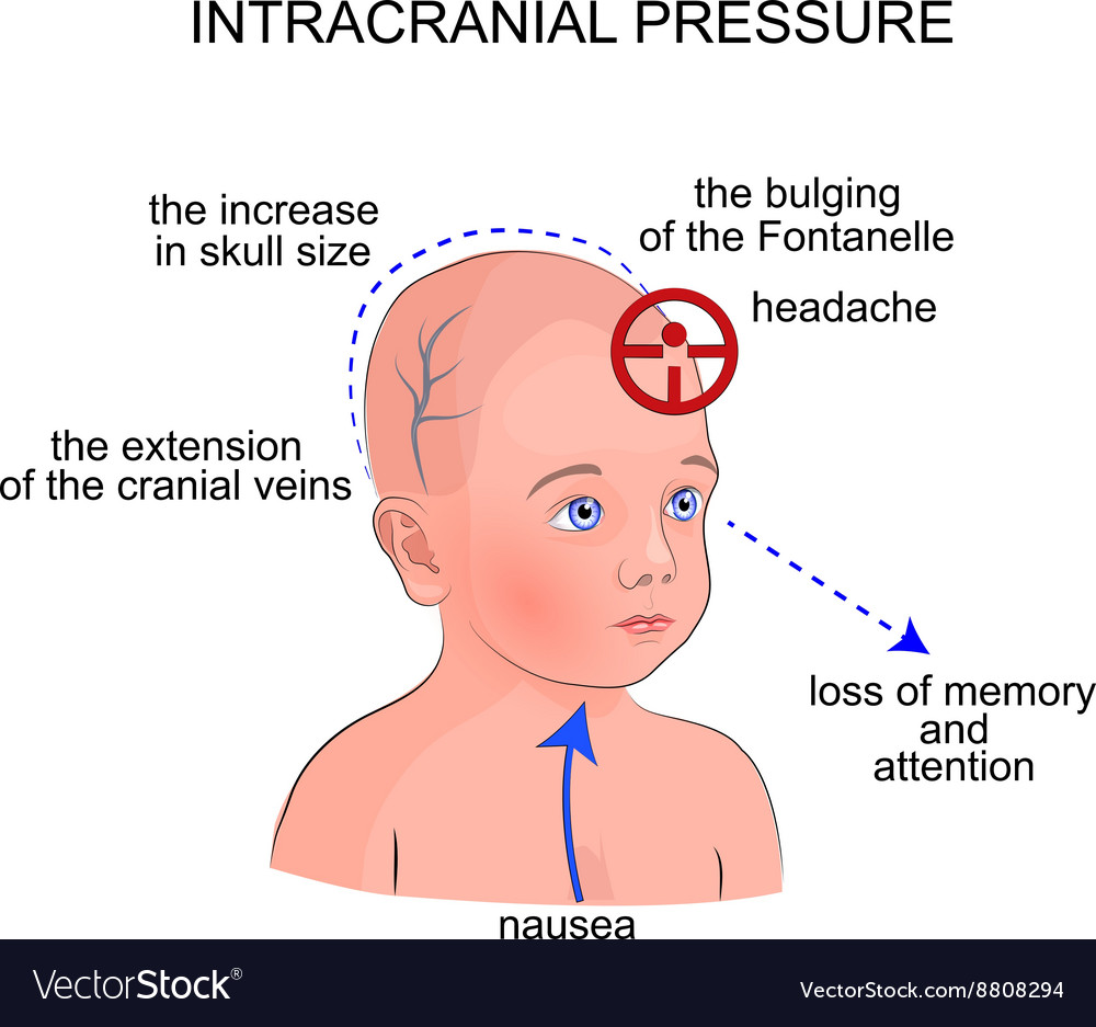 Increased Intracranial Pressure Signs And Symptoms