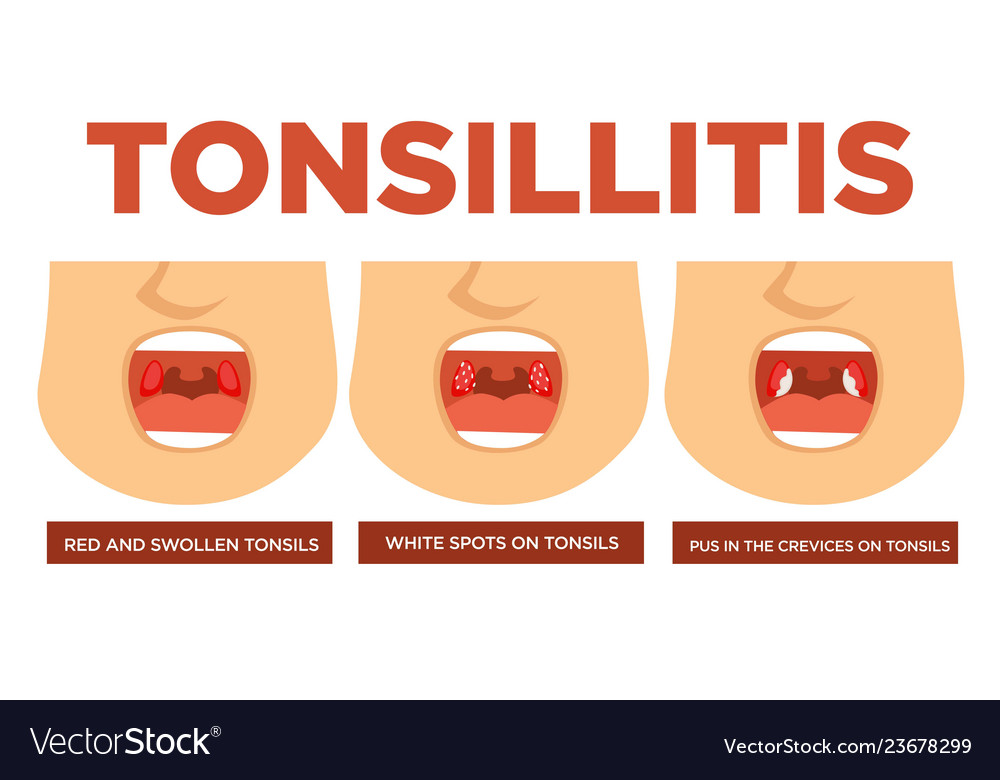 strep throat white spots on tonsils