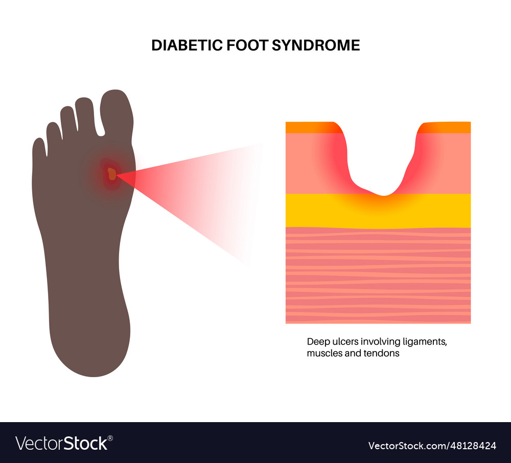 Diabetic foot ulcers Royalty Free Vector Image