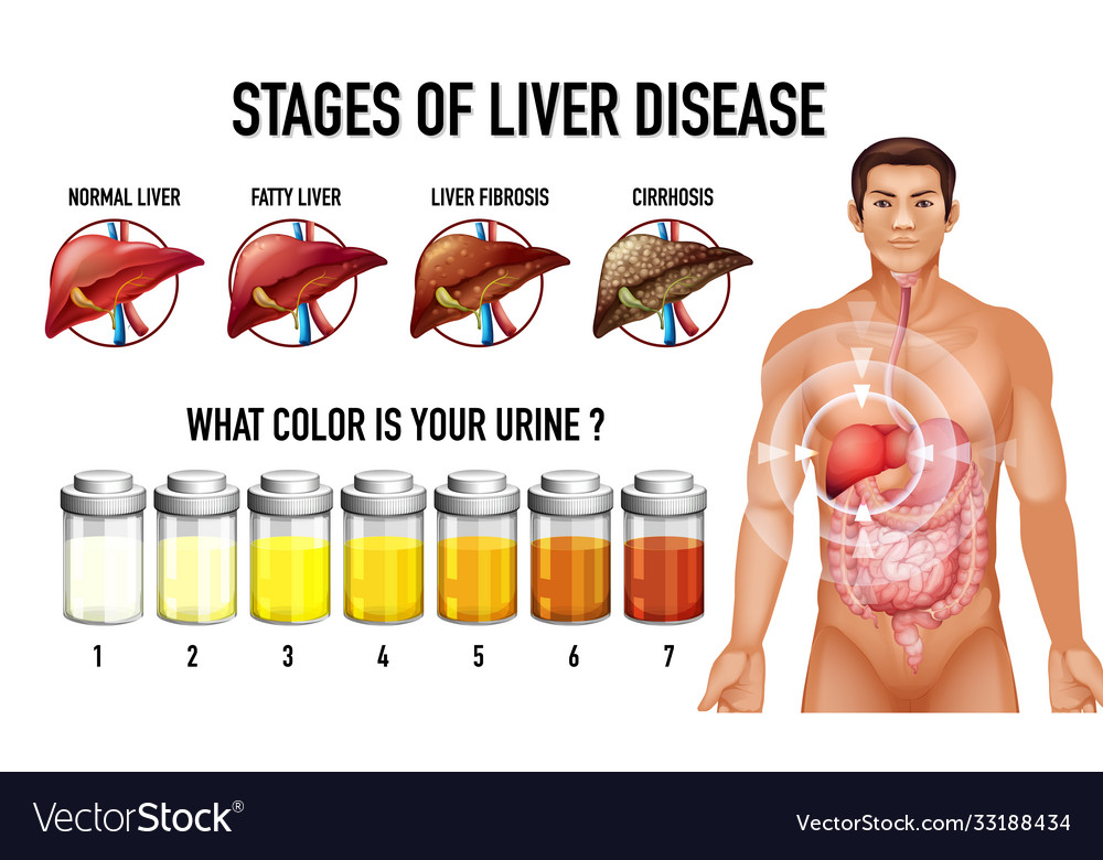 Stages liver disease Royalty Free Vector Image