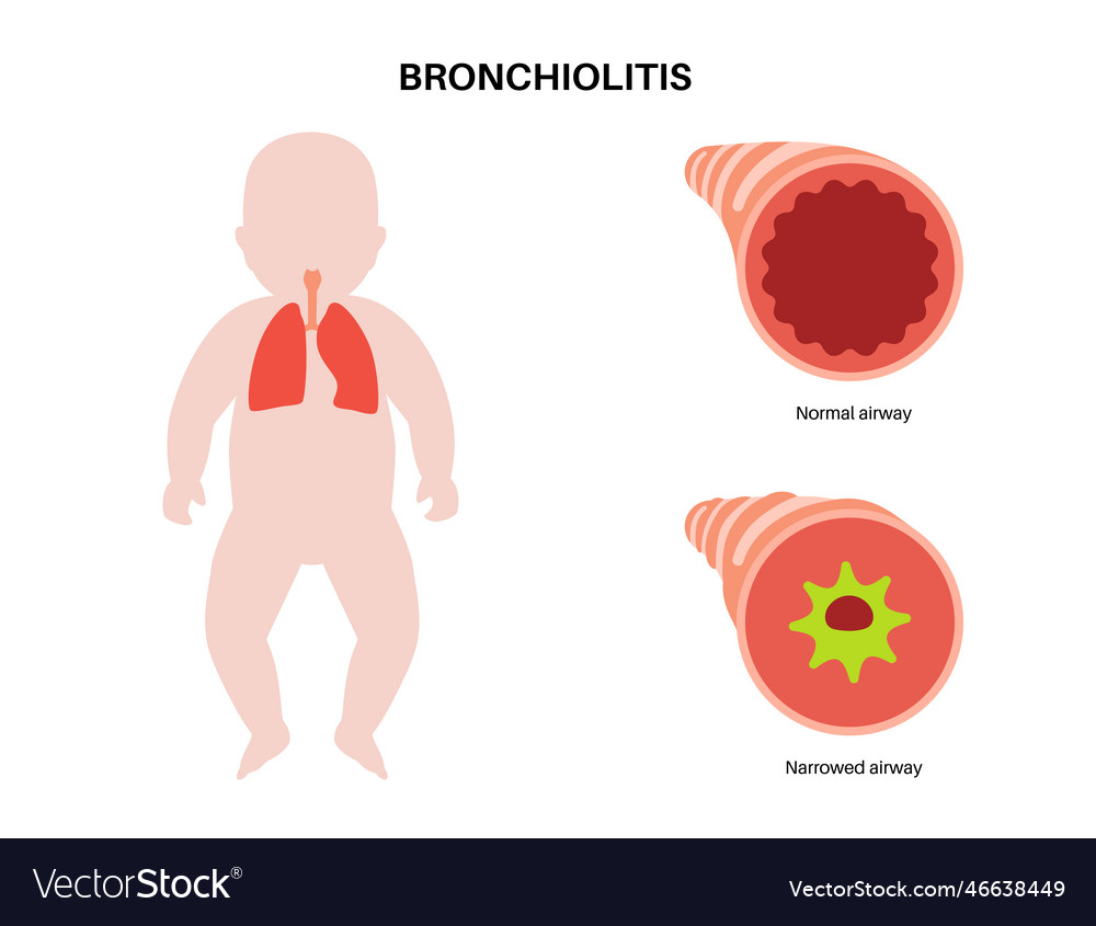 Bronchiolitis lung disease Royalty Free Vector Image