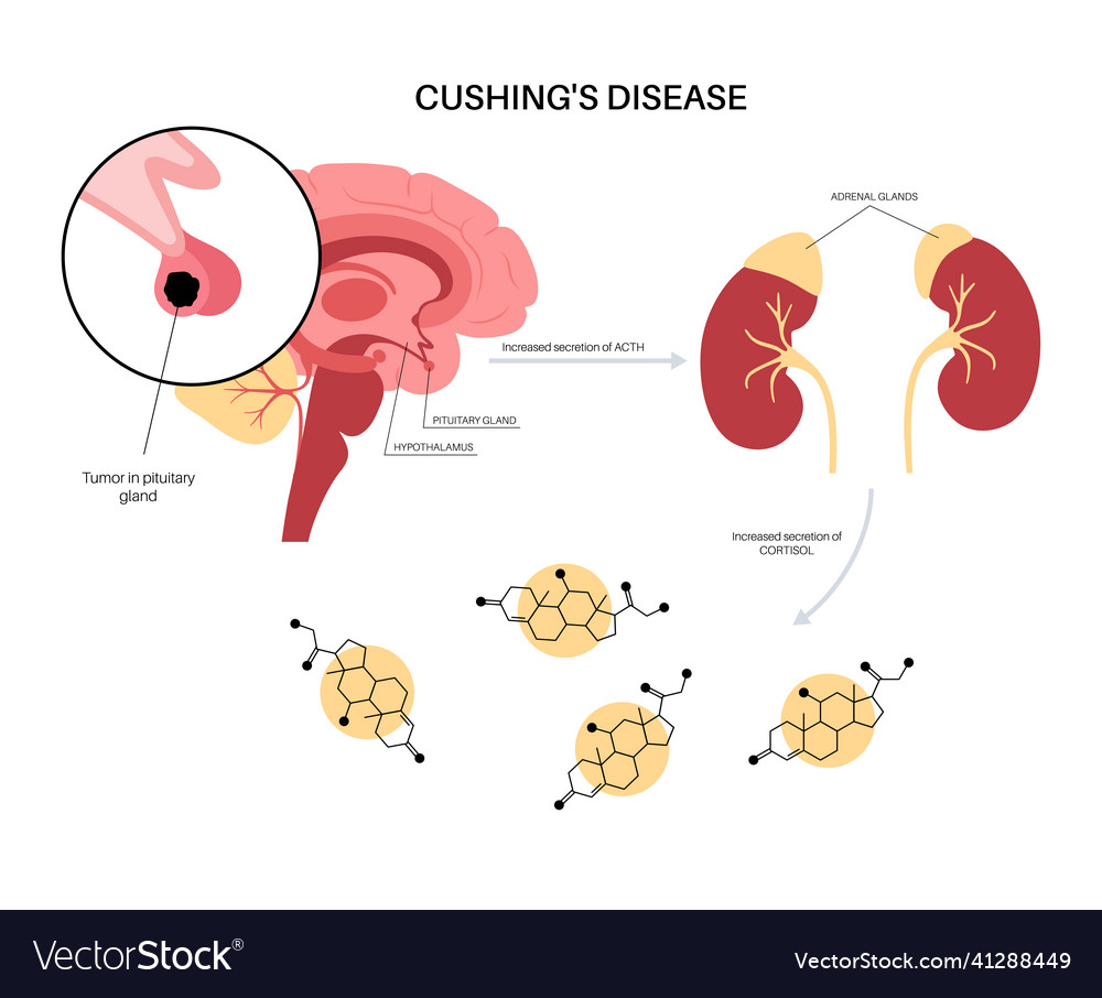 Cushing desease poster Royalty Free Vector Image