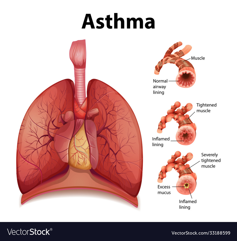 Comparison healthy lung and asthmatic Royalty Free Vector