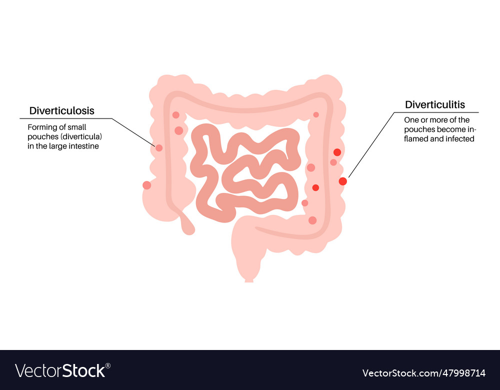 Diverticulitis and diverticulosis Royalty Free Vector Image