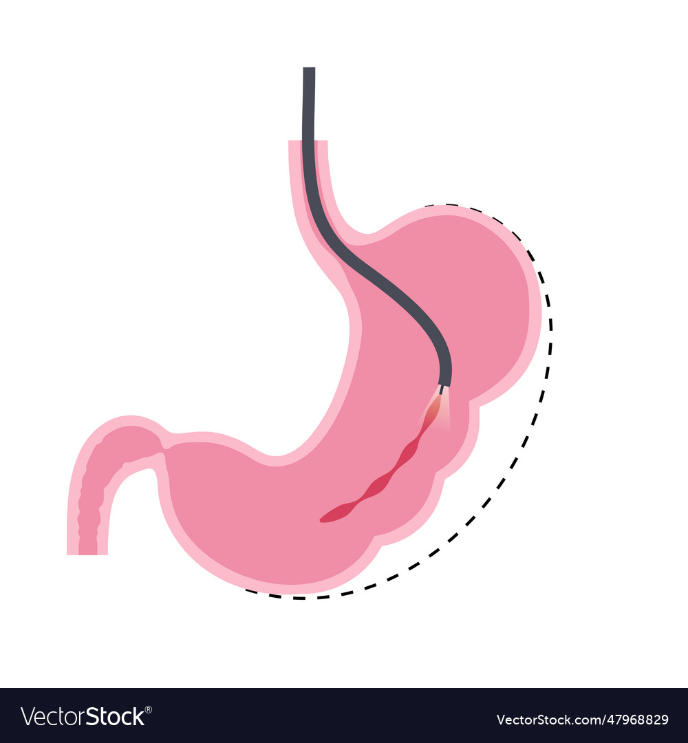 Endoscopic sleeve gastroplasty royalty free vector image