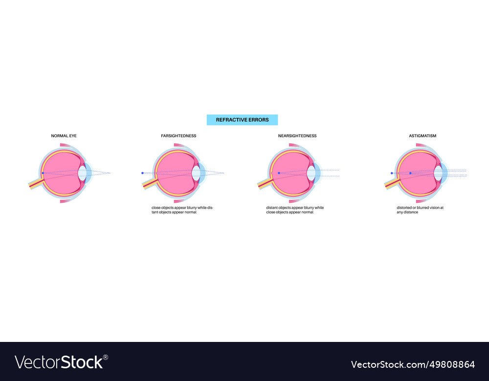 Refractive errors poster Royalty Free Vector Image