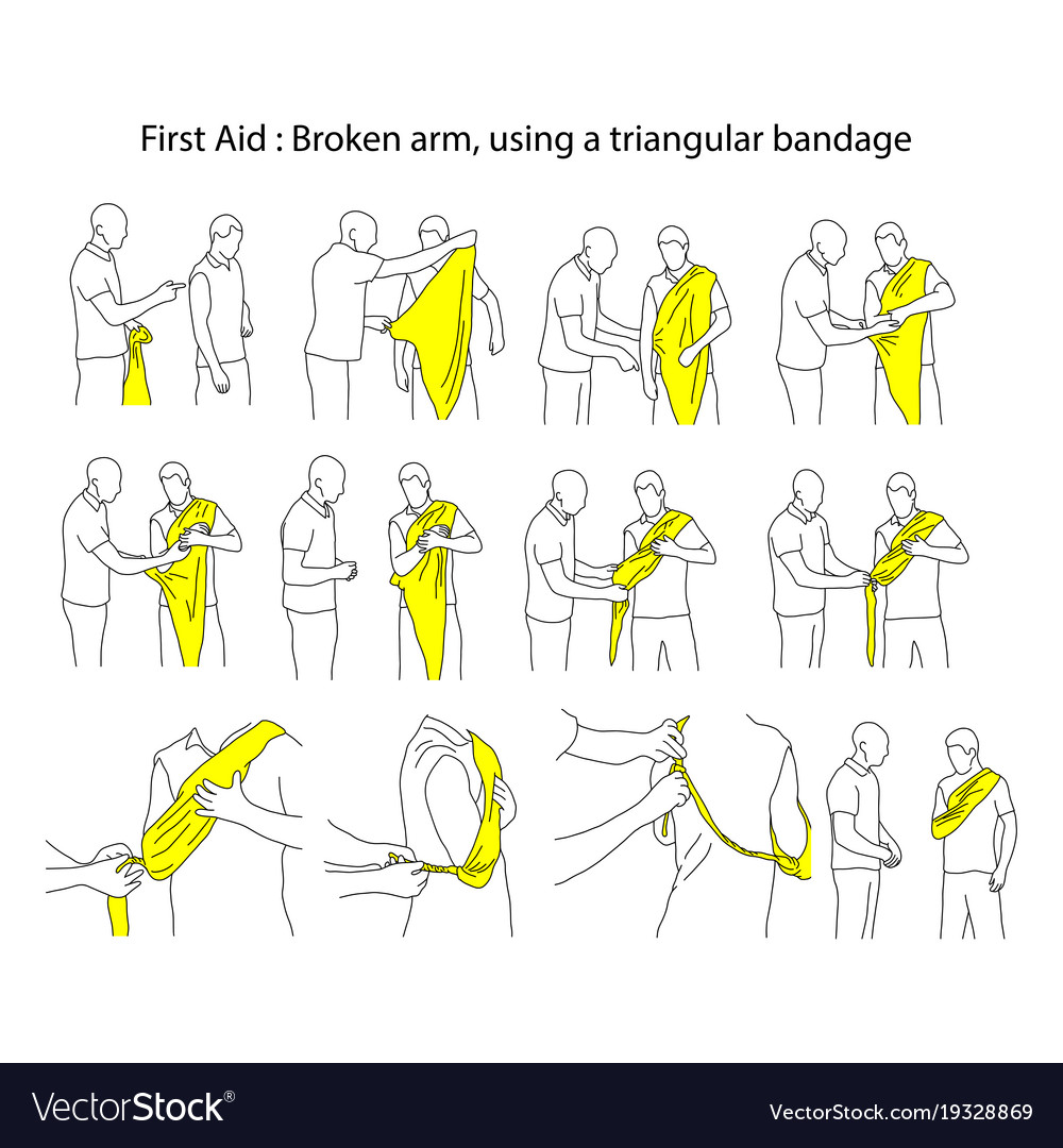 Broken arm using a triangular bandage vector illustration outline sketch ha...