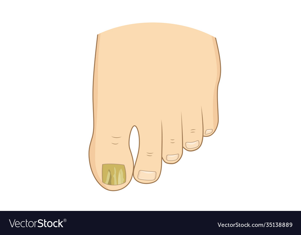 Toenail green mycosis Royalty Free Vector Image