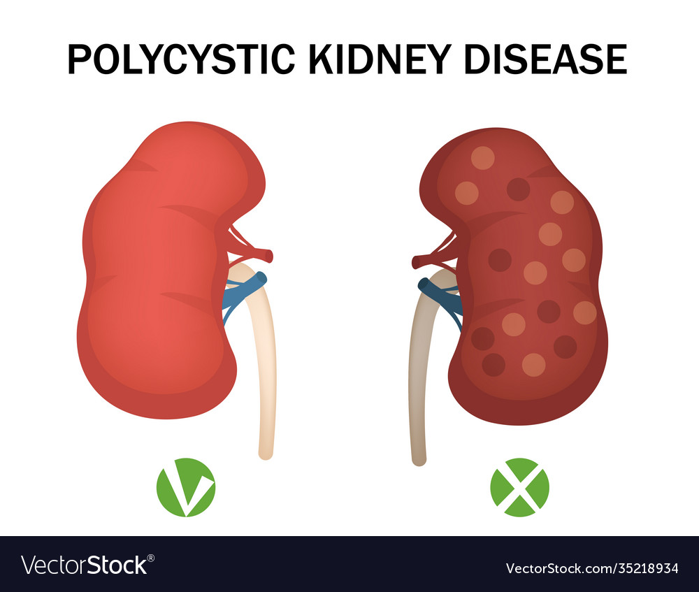 Polycystic kidney disease and healthy kidney Vector Image