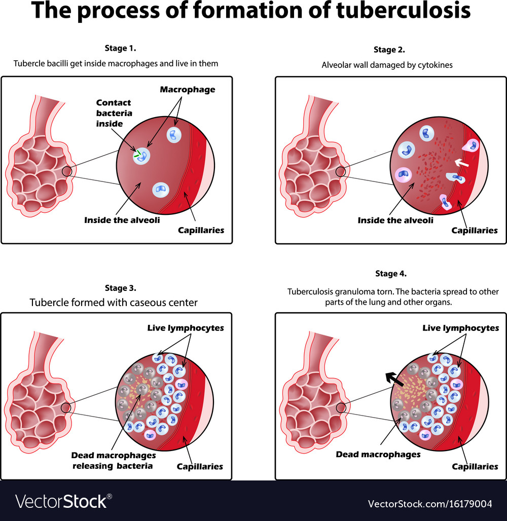 Process of tuberculosis formation Royalty Free Vector Image