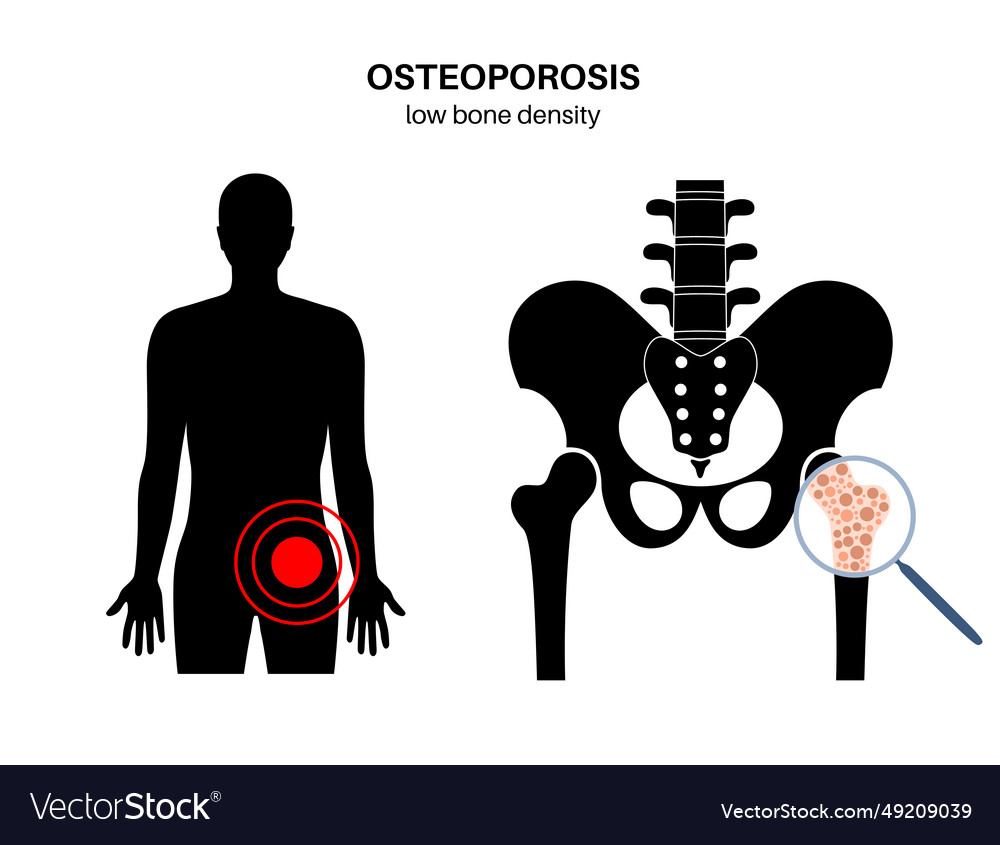 Osteoporosis medical poster Royalty Free Vector Image