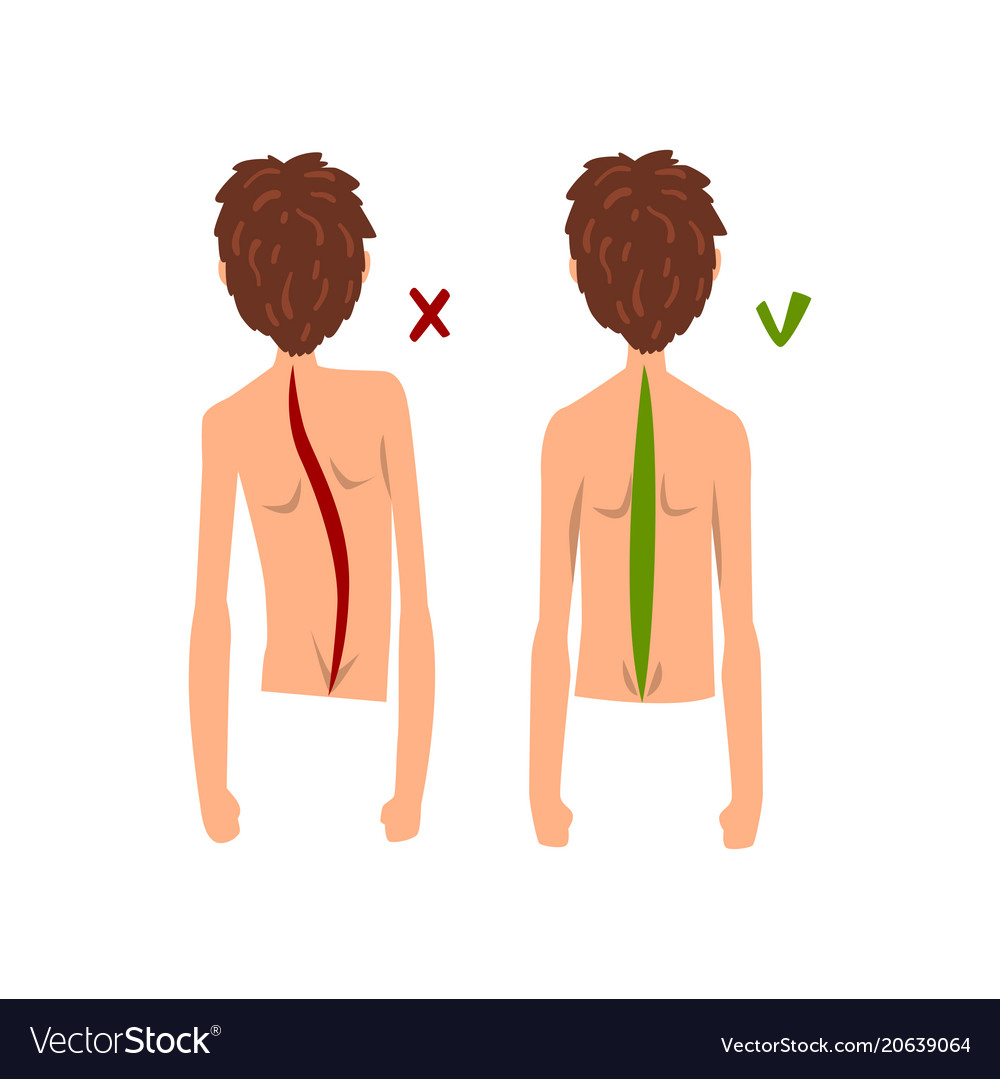 Correct and wrong spine posture back view