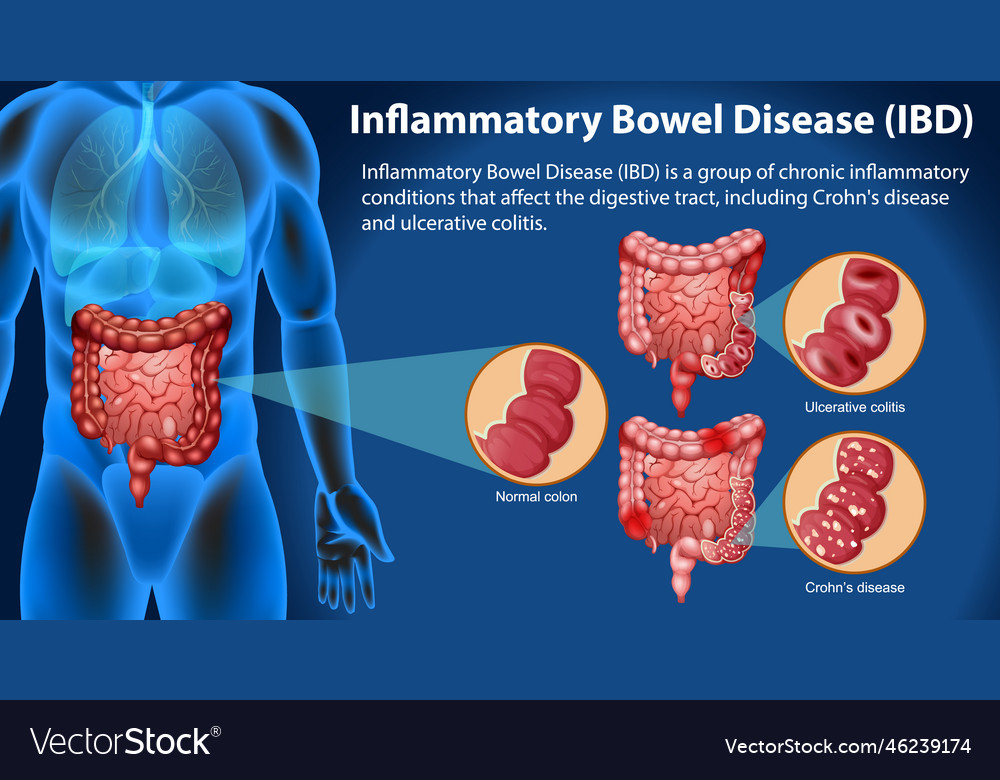 Inflammatory bowel disease ibd infographic Vector Image