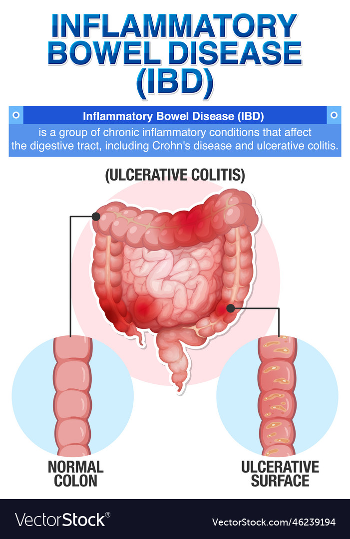 Inflammatory Bowel Disease Ibd Infographic Vector Image