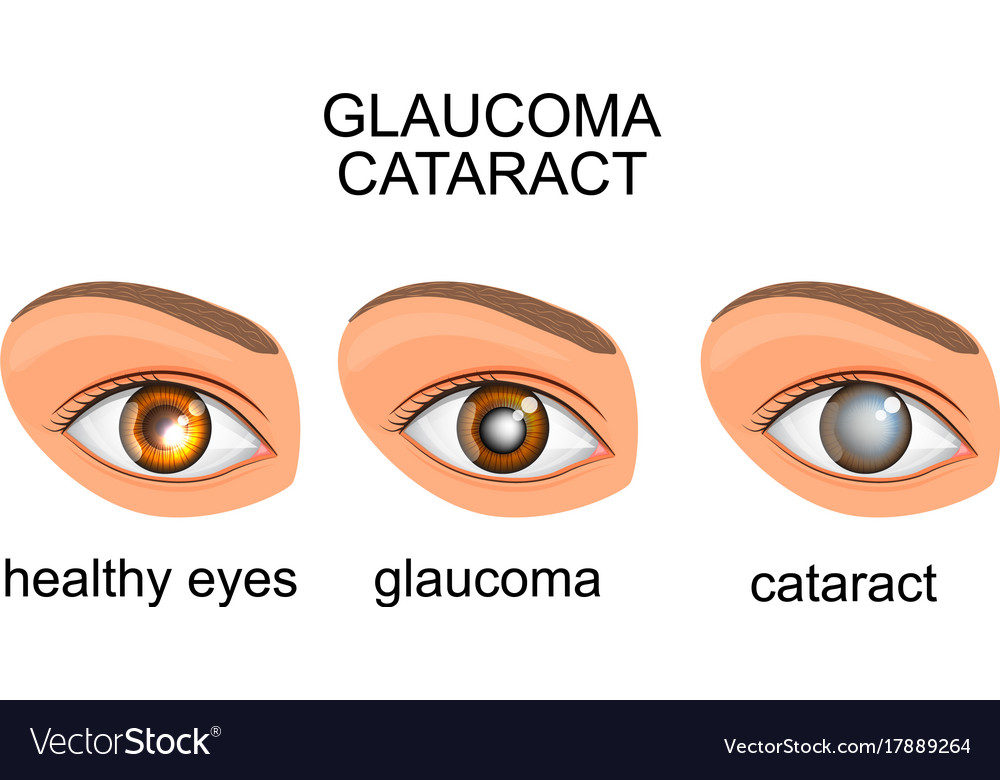 Healthy eyes glaucoma cataracts