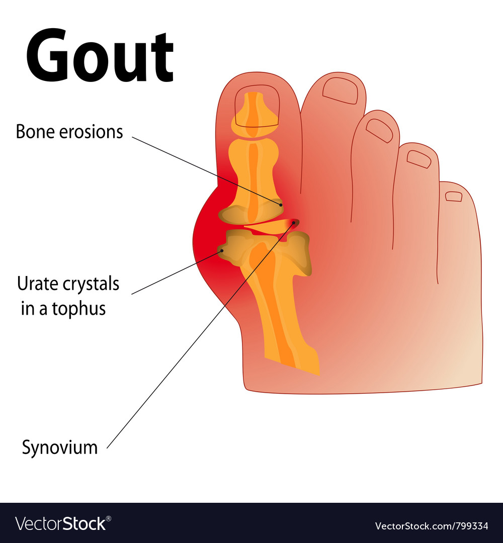 A human foot with inflamed joint Royalty Free Vector Image