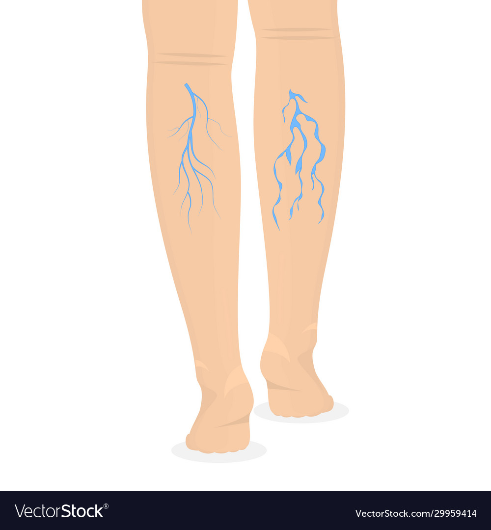 Cartoon color human legs and varicose veins