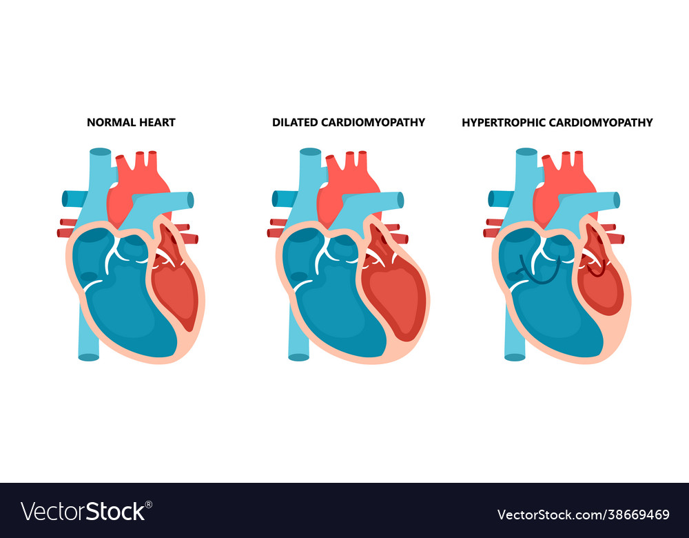 Types heart diseases - normal hypertrophic