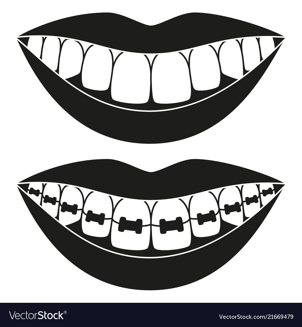 Teeth Aligning Silhouette - Before & After