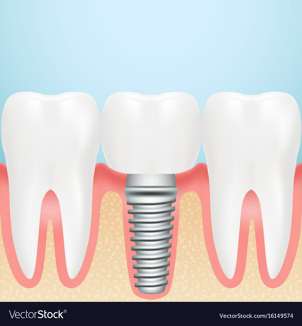 Realistic dental implant installation