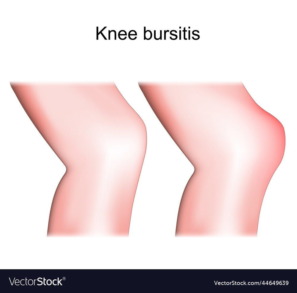 Knee Bursitis Prepatellar Bursitis Royalty Free Vector Image 7999